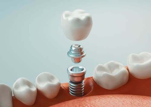 Digitally generated image of dental implant surgery — Nanodent Turkey