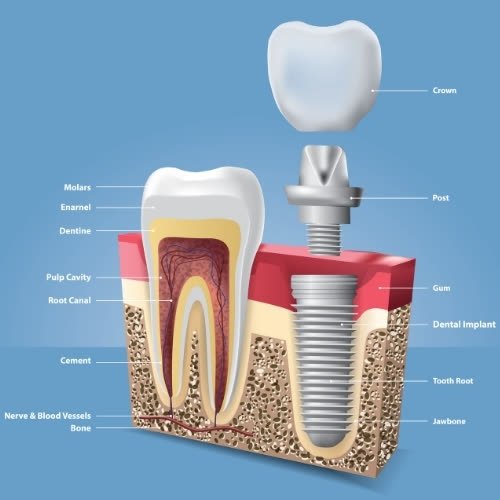 Dental Implants at Nanodent Centre Turkey in Antalya — treatment photo 1
