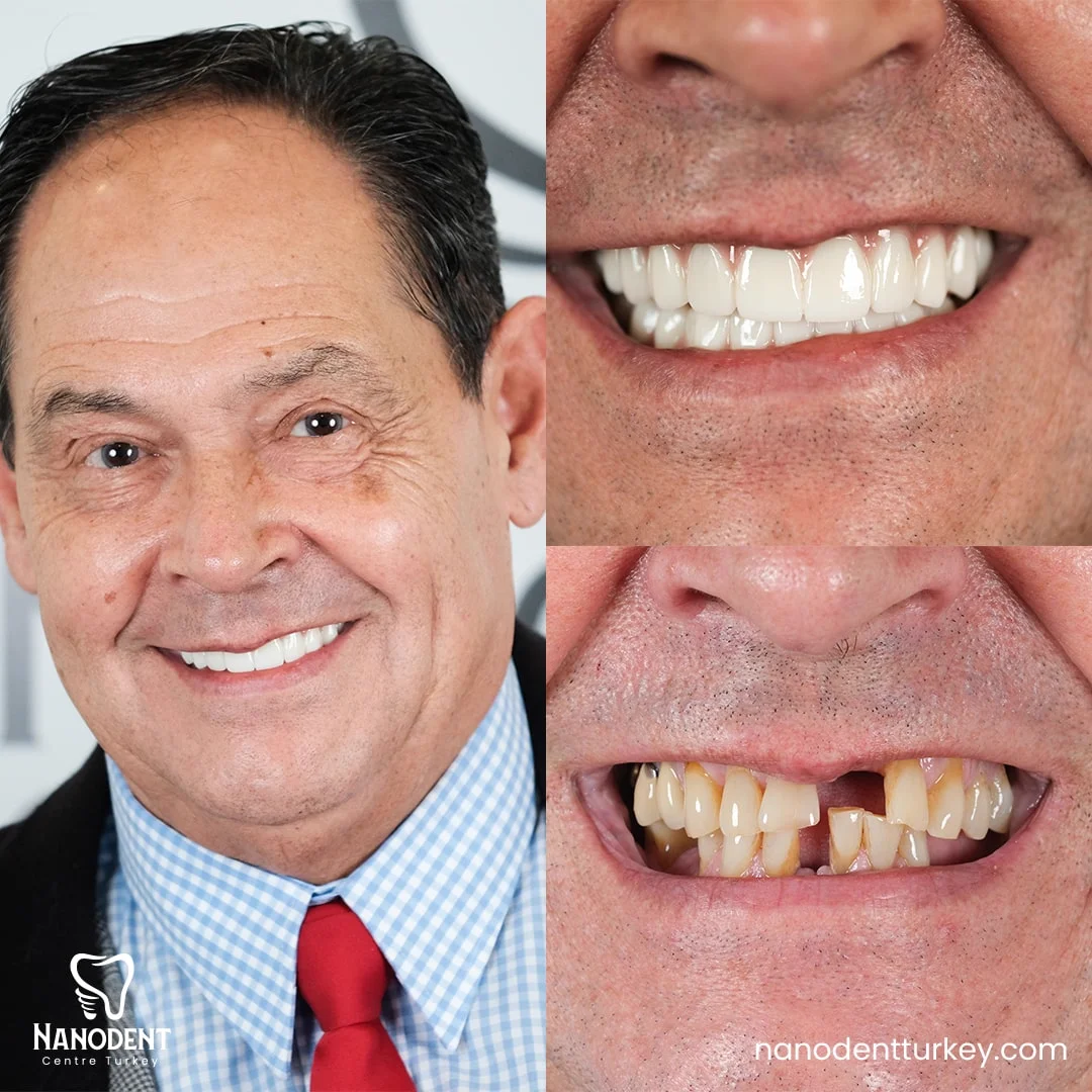 Gabriel — All-on-6 before and after
