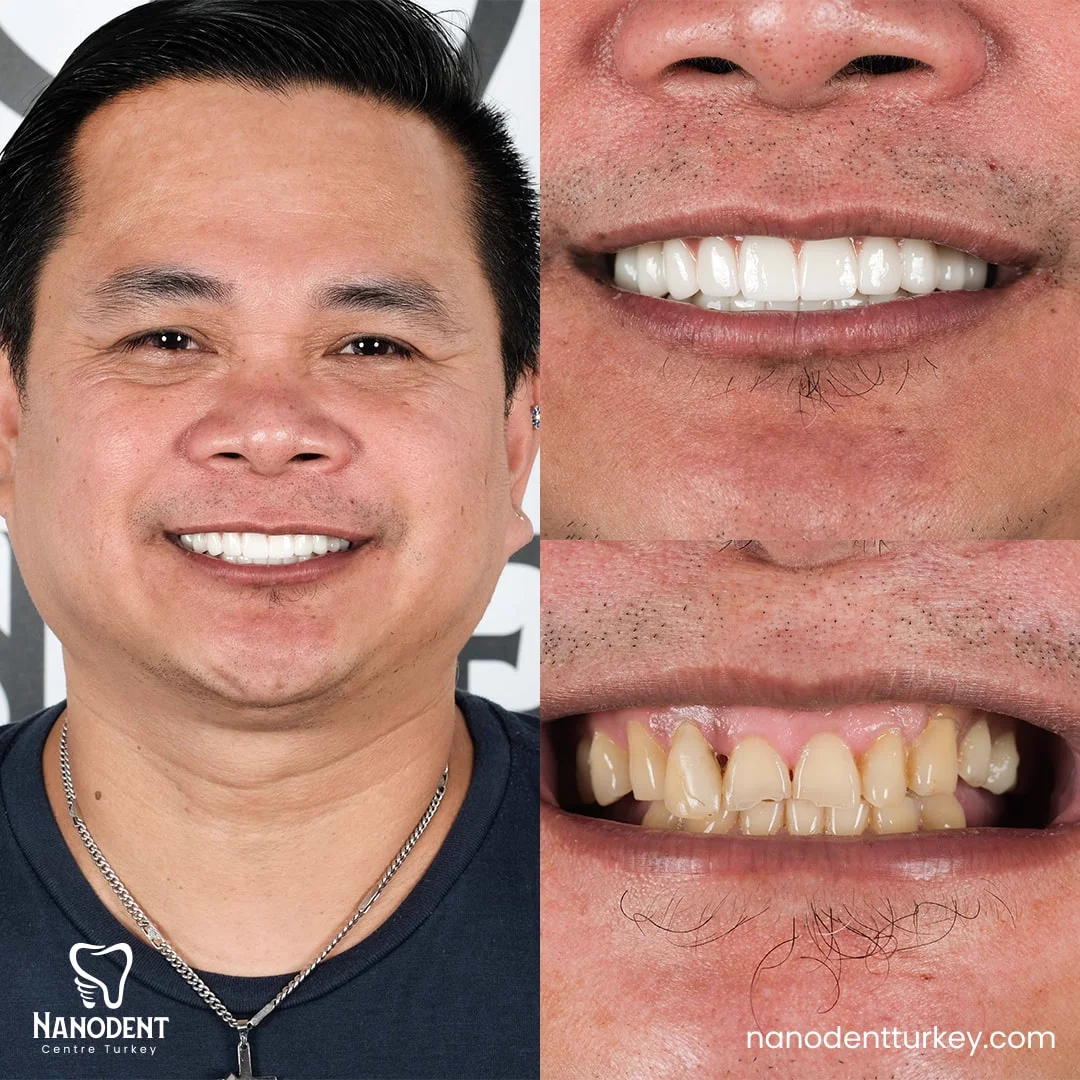 Joel — All-on-6 before and after