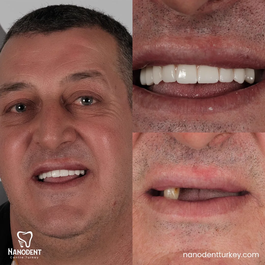 Mabrouk — All-on-6 before and after