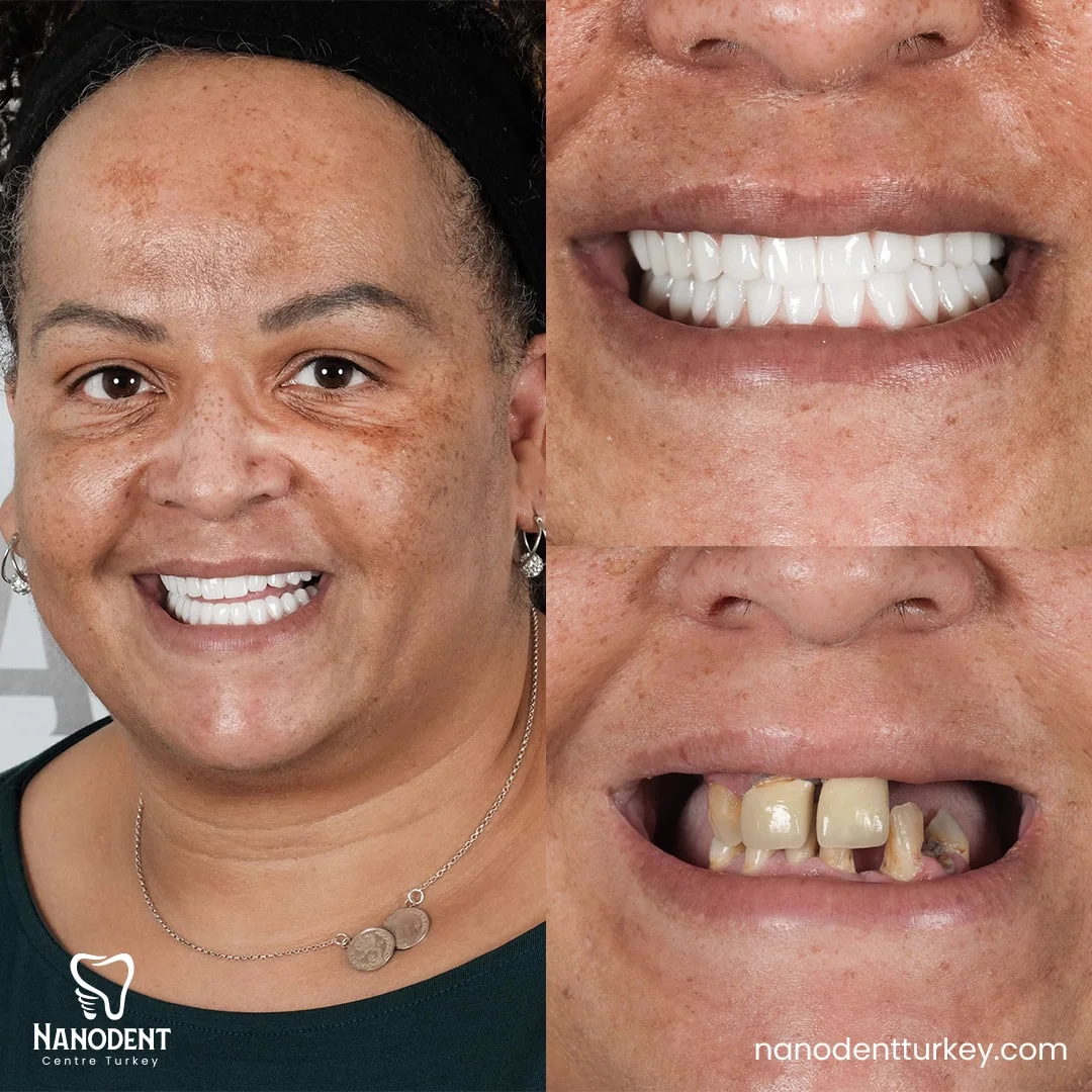 Remi — All-on-6 before and after
