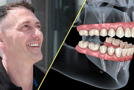 Que comprend le traitement All on 6 et est il adapté à mon cas ?