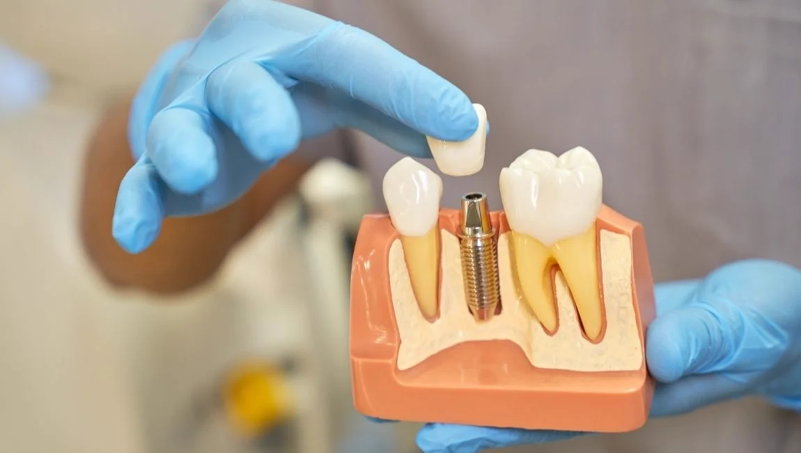 Guide 2026: principales différences entre les implants dentaires All on 4 et All on 6