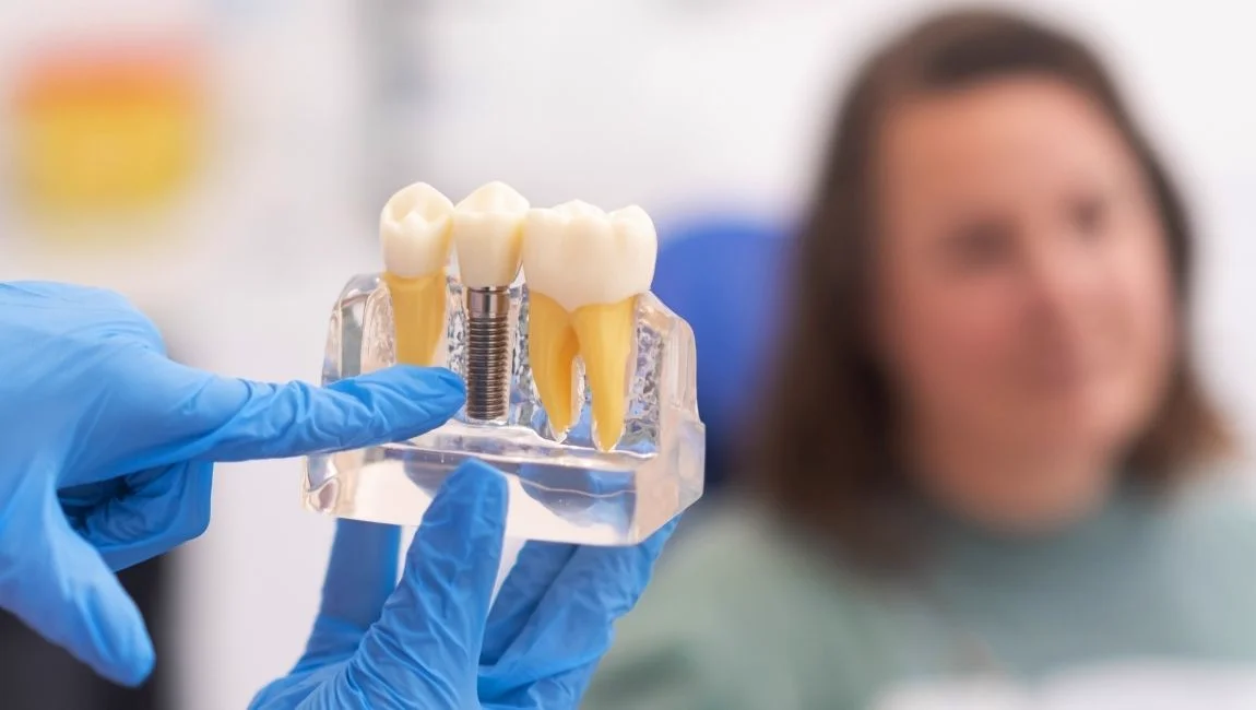 All on 4 vs implants traditionnels: lequel est le meilleur ? | Nanodent Turkey Antalya