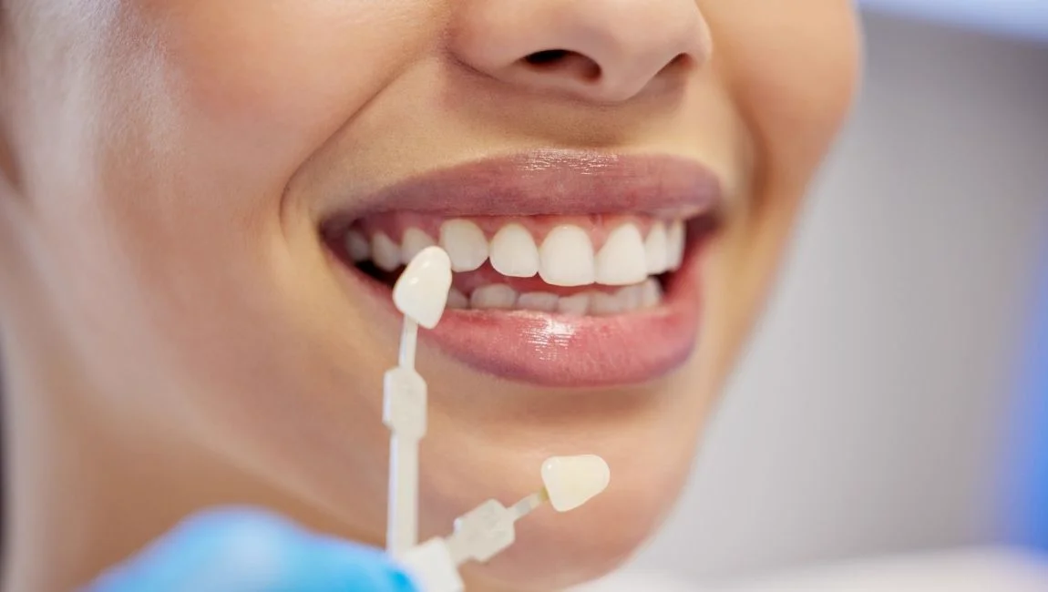 5 avantages des facettes en zirconium à Antalya