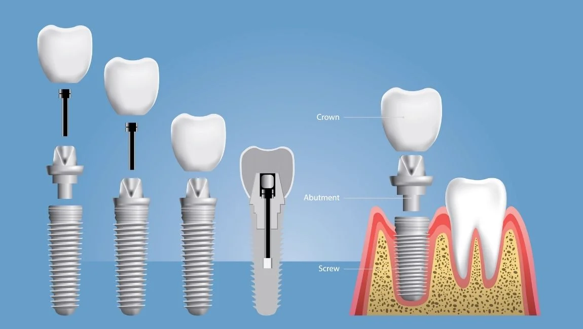 Qu’est ce qu’un pilier Multi Unit ? Comment est il fabriqué ?