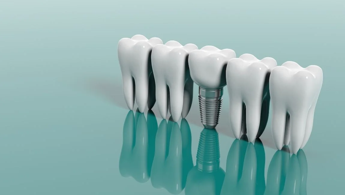 Combien coûtent les implants dentaires à Antalya ? Le meilleur endroit en Turquie pour les soins dentaires