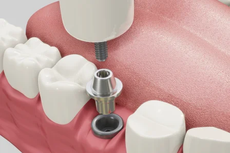 7 Avantages des Implants Dentaires