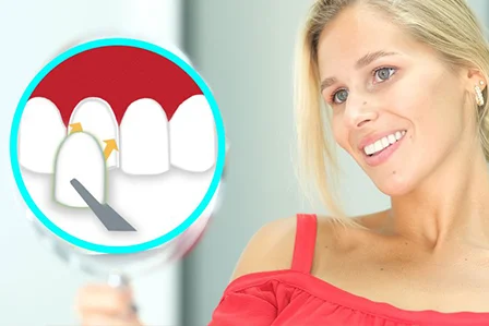 Quels sont les différents types de facettes dentaires ?
