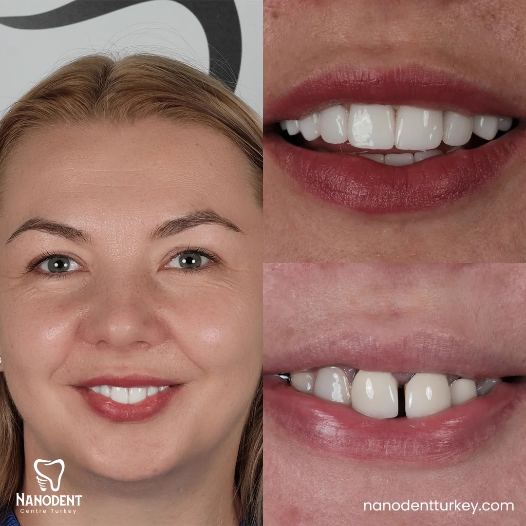 Anetta — Transformation du sourire