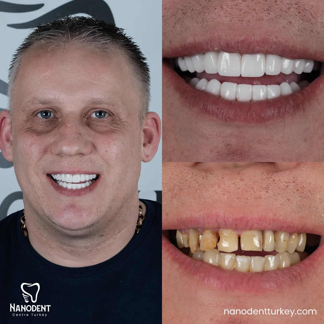 Gareth — Transformation du sourire