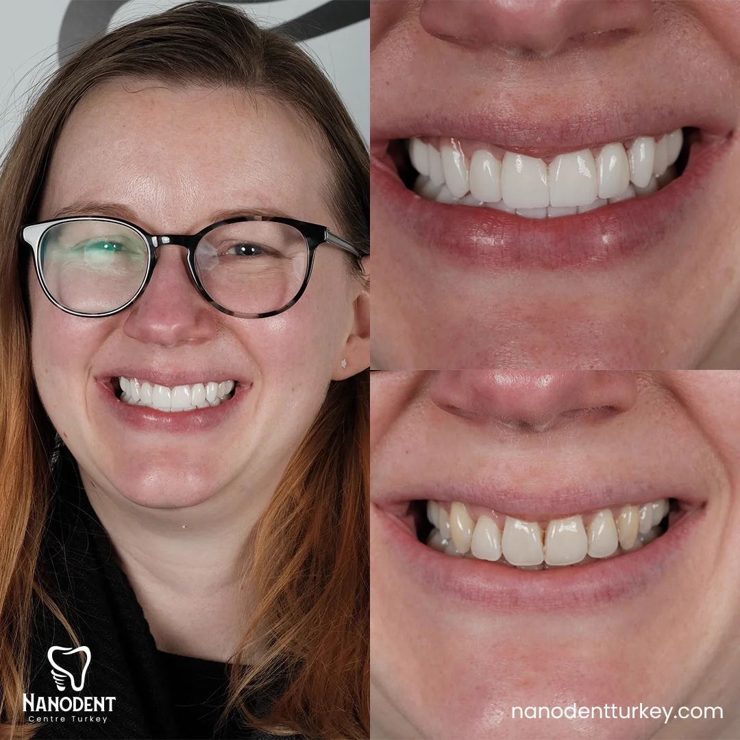 Joanne — Transformation du sourire