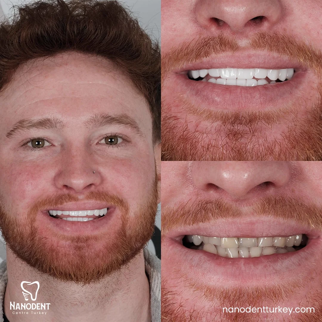 Kieran — Transformation du sourire