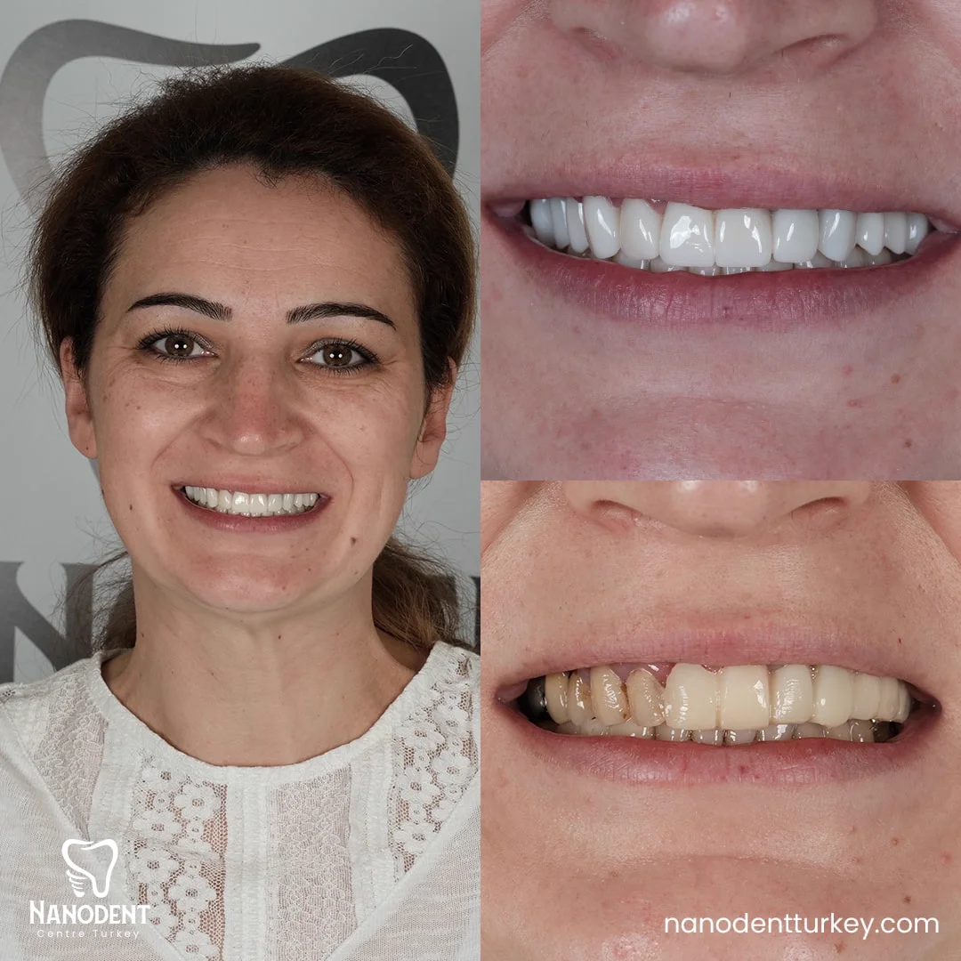 Oana — Transformation du sourire
