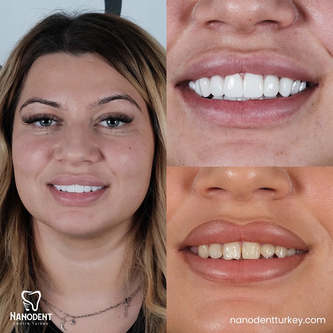 Roxana — Transformation du sourire