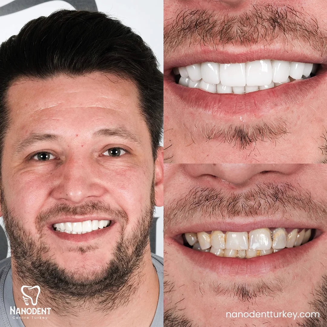 Timothy — Transformation du sourire