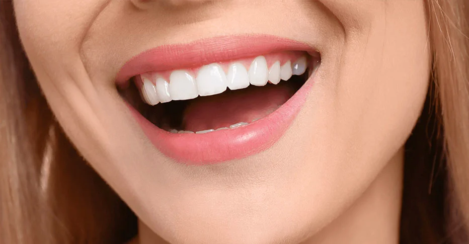 Hollywood Smile